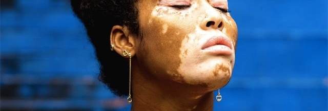 vitiligo-temoignages